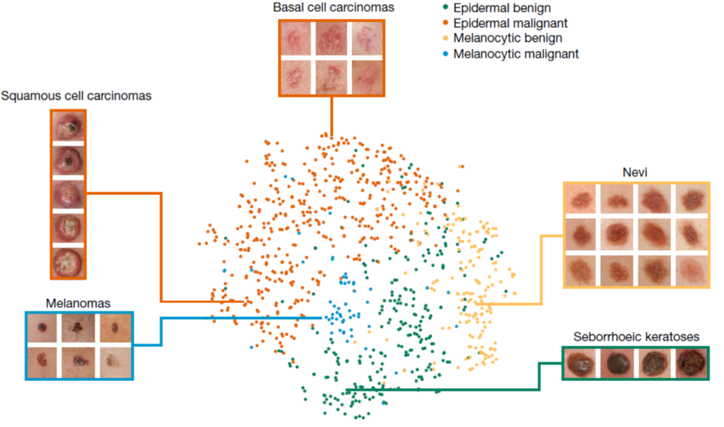 IA classification cancer peau