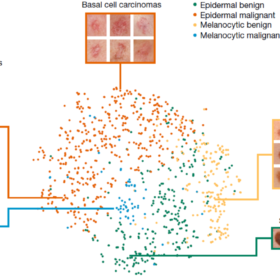 IA classification cancer peau