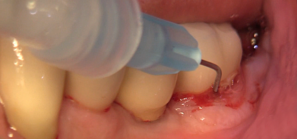 élimination du biofilm dentaire